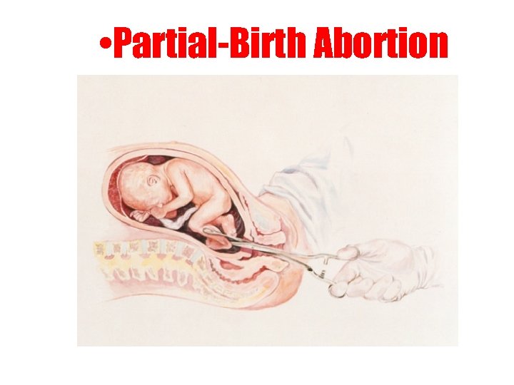  • Partial-Birth Abortion 