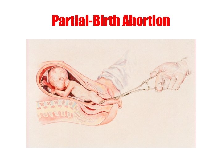 Partial-Birth Abortion 
