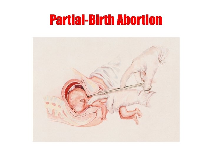 Partial-Birth Abortion 