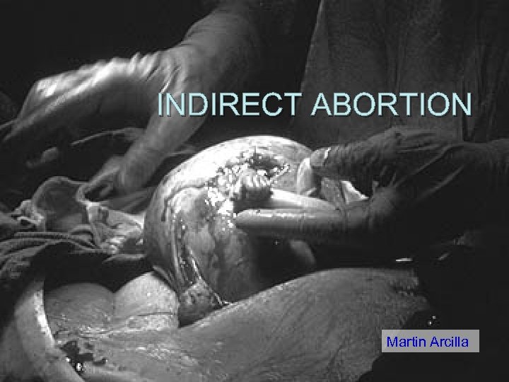 INDIRECT ABORTION Martin Arcilla 