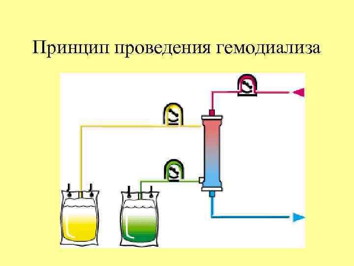 Принцип проведения гемодиализа 