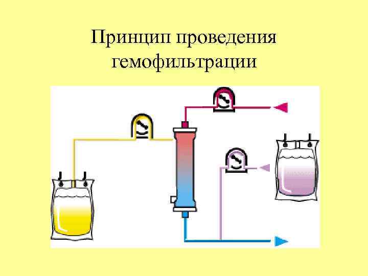 Принцип проведения гемофильтрации 