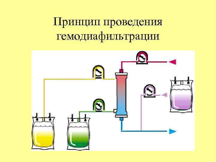 Принцип проведения гемодиафильтрации 