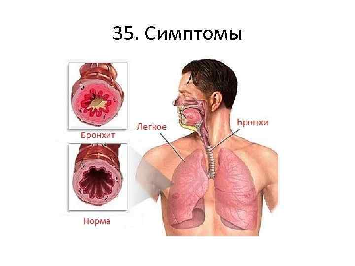 35. Симптомы 