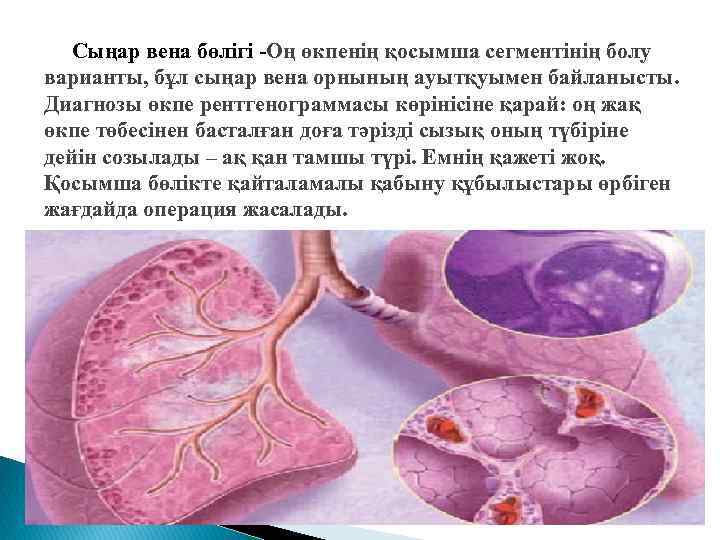 Сыңар вена бөлігі -Оң өкпенің қосымша сегментінің болу варианты, бұл сыңар вена орнының ауытқуымен
