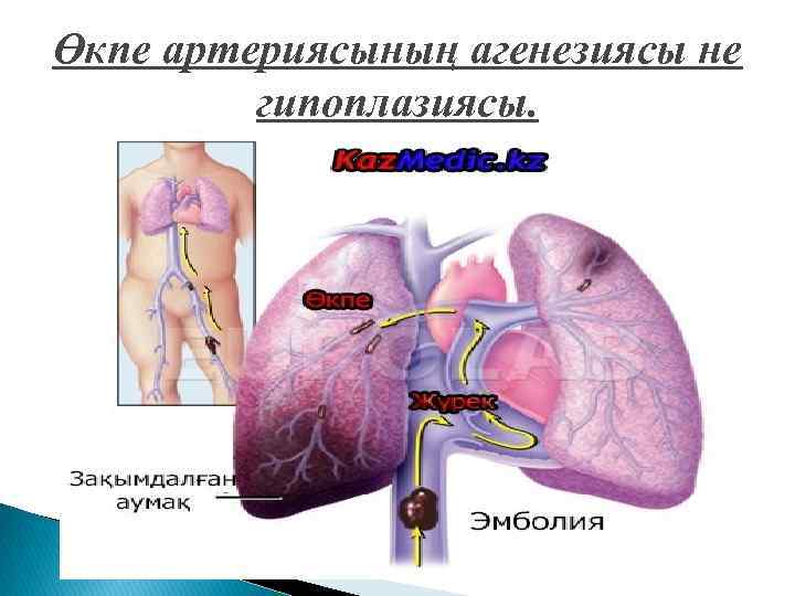 Өкпе артериясының агенезиясы не гипоплазиясы. 