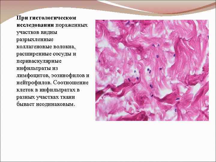 При гистологическом исследовании пораженных участков видны разрыхленные коллагеновые волокна, расширенные сосуды и периваскулярные инфильтраты