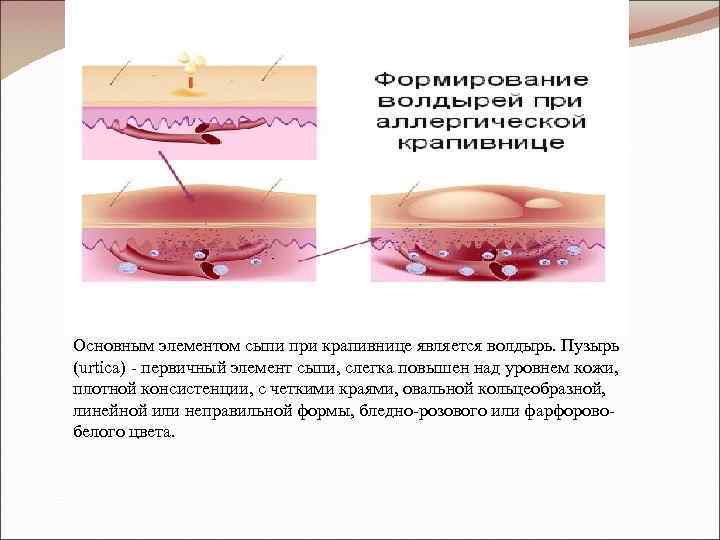 Основным элементом сыпи при крапивнице является волдырь. Пузырь (urtica) - первичный элемент сыпи, слегка