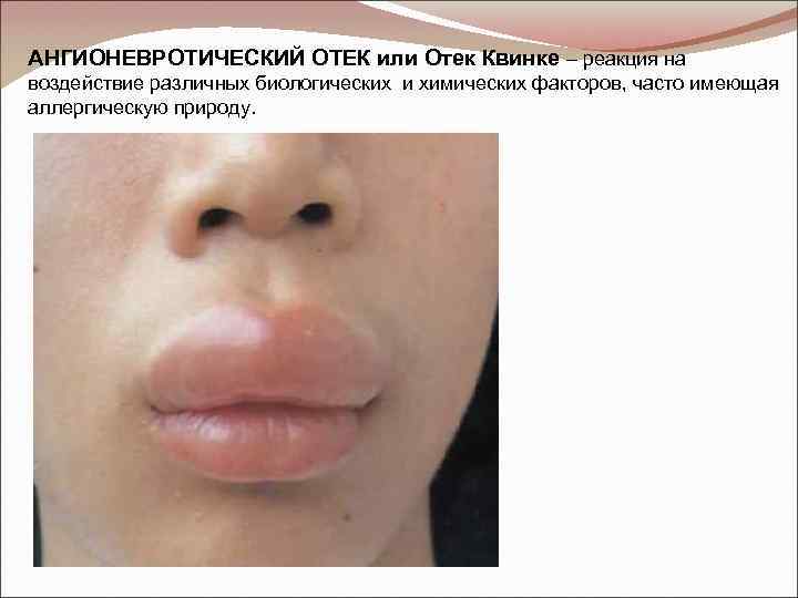 АНГИОНЕВРОТИЧЕСКИЙ ОТЕК или Отек Квинке – реакция на воздействие различных биологических и химических факторов,
