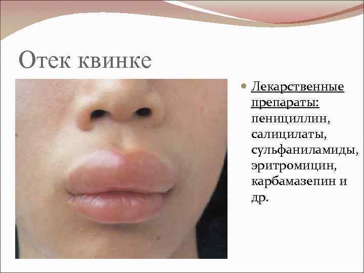 Отек квинке Лекарственные препараты: пенициллин, салицилаты, сульфаниламиды, эритромицин, карбамазепин и др. 