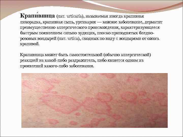 Крапи вница (лат. urticaria), называемая иногда крапивная лихорадка, крапивная сыпь, уртикария — кожное заболевание,