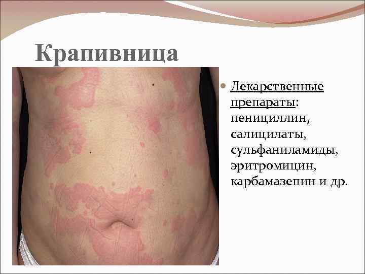  Крапивница Лекарственные препараты: пенициллин, салицилаты, сульфаниламиды, эритромицин, карбамазепин и др. 