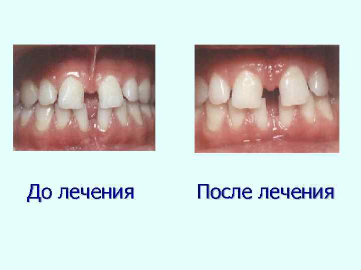 До лечения После лечения 