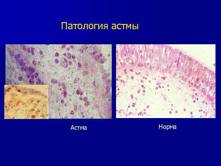 Патология астмы Астма Норма 