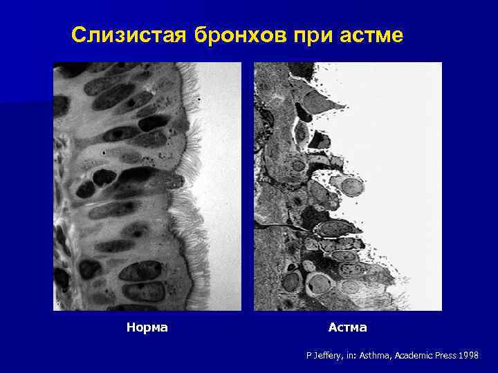 Образование отложений на стенках бронхов