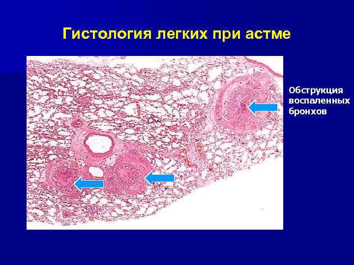 Гистология легких при астме Обструкция воспаленных бронхов 