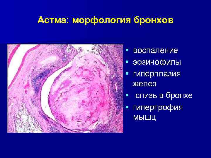 Гиперплазия желез. Бронхиальная астма микропрепарат. Атопическая бронхиальная астма микропрепарат. Бронхов при бронхиальной астме микропрепарат. Бронхиальная астма гистология.