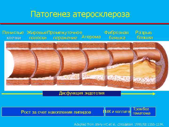 Схема развития атеросклероза