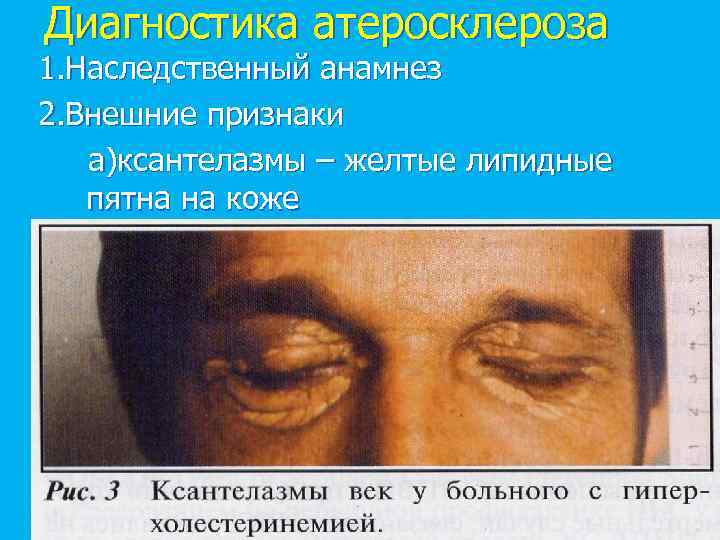 Диагностика атеросклероза 1. Наследственный анамнез 2. Внешние признаки а)ксантелазмы – желтые липидные пятна на