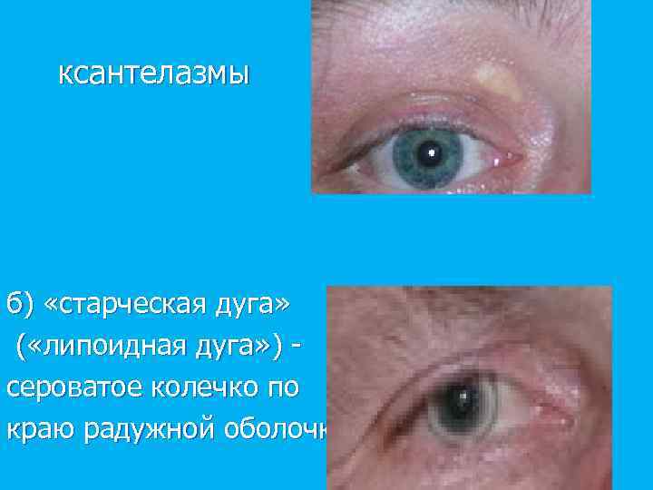 ксантелазмы б) «старческая дуга» ( «липоидная дуга» ) сероватое колечко по краю радужной оболочки