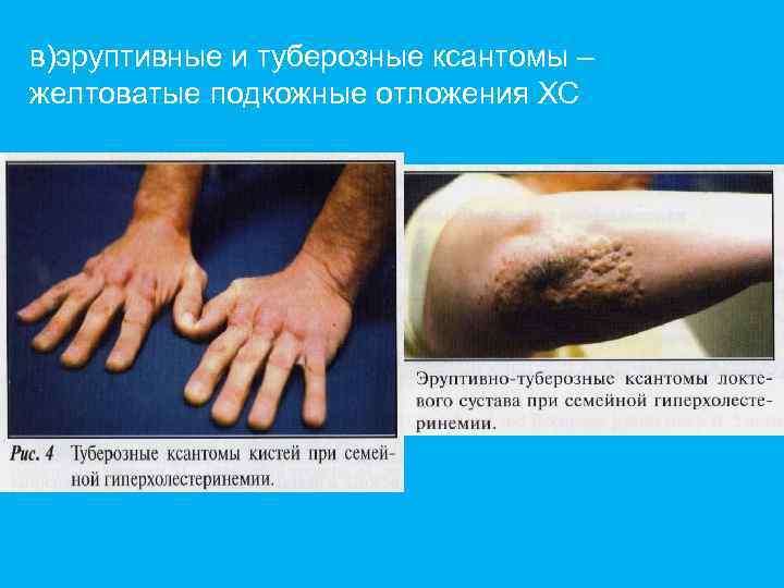 в)эруптивные и туберозные ксантомы – желтоватые подкожные отложения ХС 