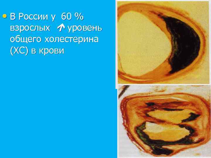  • В России у 60 % взрослых уровень общего холестерина (XC) в крови