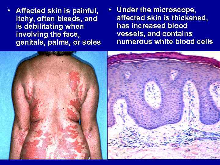  • Affected skin is painful, • Under the microscope, affected skin is thickened,