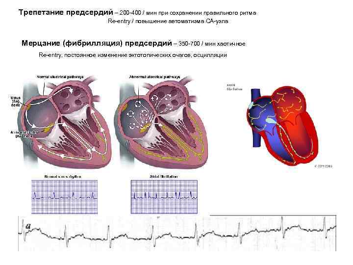 Трепетание предсердий – 200 -400 / мин при сохранении правильного ритма Re-entry / повышение