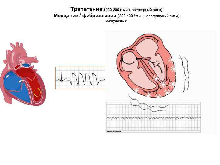 Трепетание (200 -300 в мин, регулярный ритм) Мерцание / фибрилляция (200 -500 / мин,