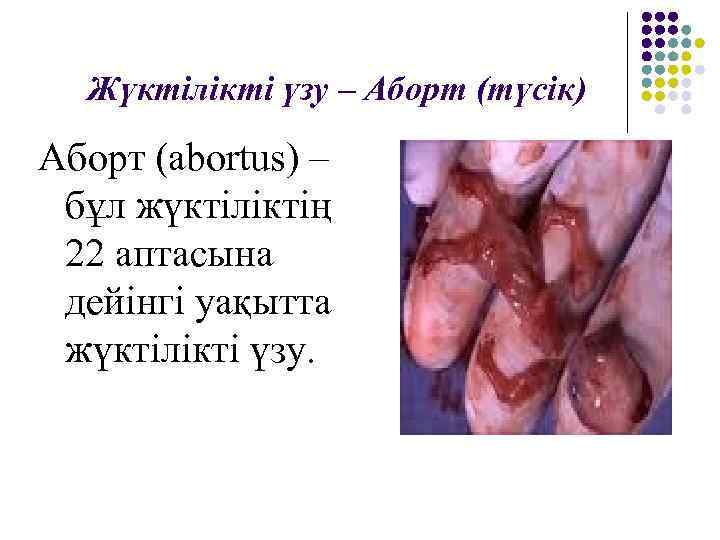 Жүктілікті үзу – Аборт (түсік) Аборт (abortus) – бұл жүктіліктің 22 аптасына дейінгі уақытта