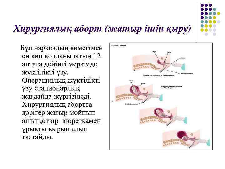 Хирургиялық аборт (жатыр ішін қыру) Бұл наркоздың көмегімен ең көп қолданылатын 12 аптага дейінгі