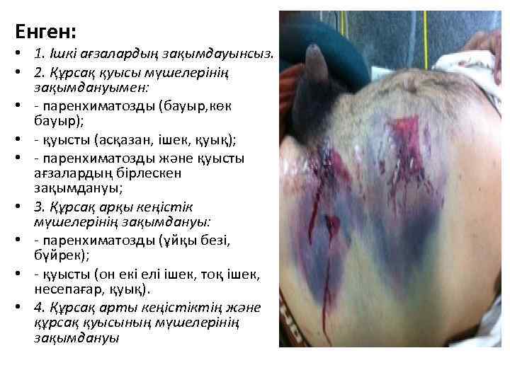 Енген: • 1. Ішкі ағзалардың зақымдауынсыз. • 2. Құрсақ қуысы мүшелерінің зақымдануымен: • -