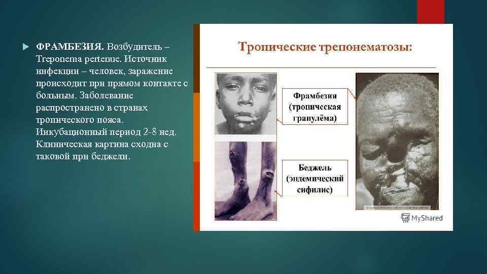  ФРАМБЕЗИЯ. Возбудитель – Treponema pertenue. Источник инфекции – человек, заражение происходит при прямом