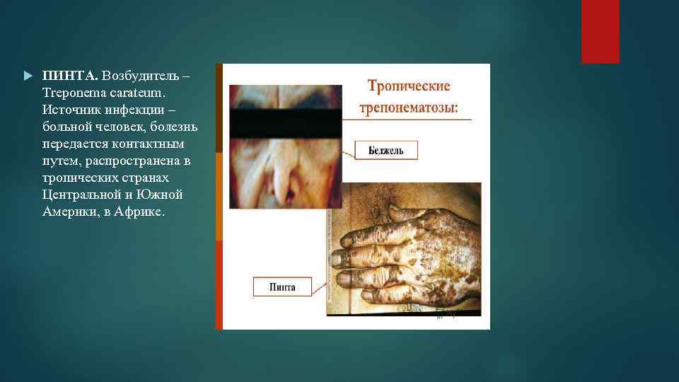  ПИНТА. Возбудитель – Treponema carateum. Источник инфекции – больной человек, болезнь передается контактным