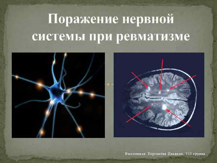 Поражение нервной системы при ревматизме Выполнила: Борганова Ильвина, 313 группа 