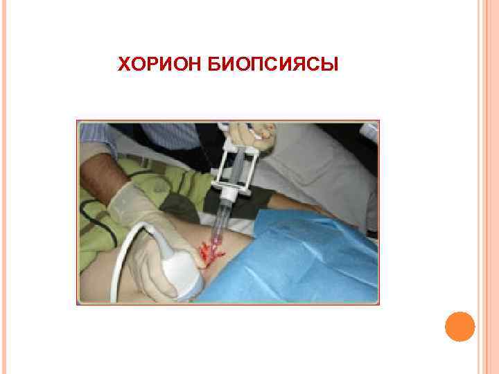 ХОРИОН БИОПСИЯСЫ 