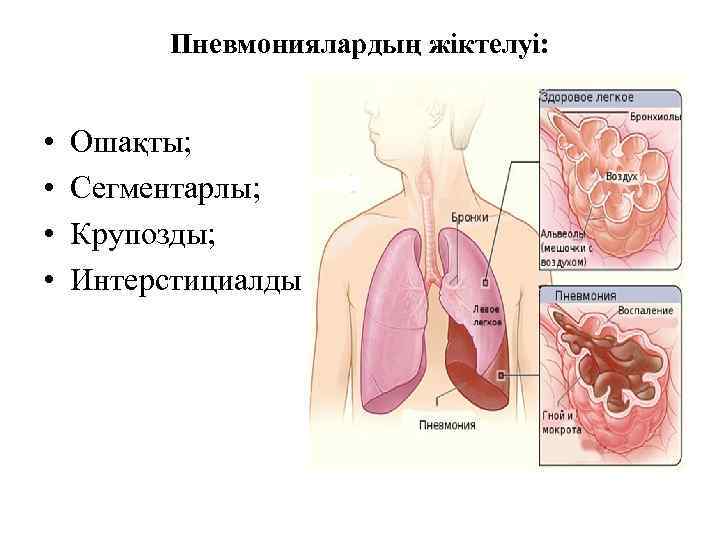 Пневмониялардың жіктелуі: • • Ошақты; Сегментарлы; Крупозды; Интерстициалды 