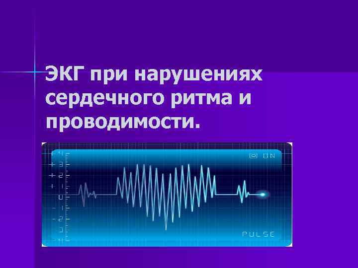 ЭКГ при нарушениях сердечного ритма и проводимости. 