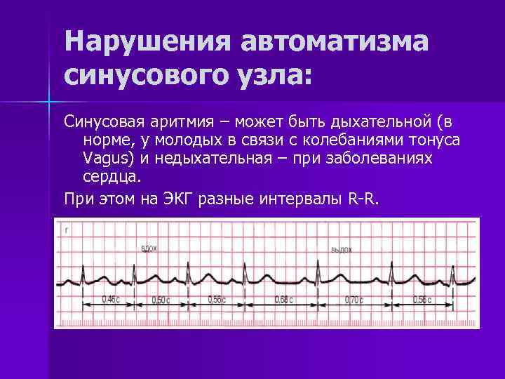 Что значит синусовый ритм сердца на экг. Синусовая дыхательная аритмия на ЭКГ. Синусовая аритмия на ЭКГ расшифровка. Синусовая аритмия на ЭКГ. Синусовая аритмия на ЭКГ норма.