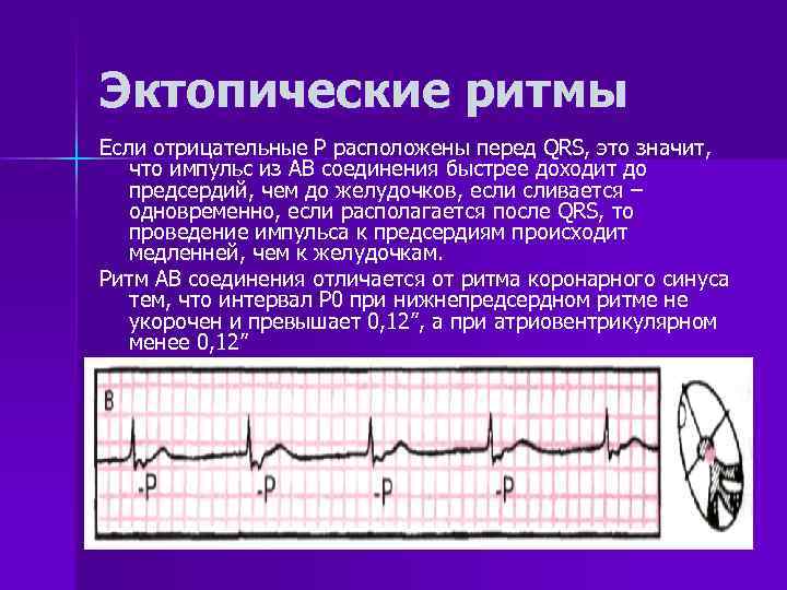 Эктопический ритм. Эктопическая аритмия на ЭКГ. Эктопический ритм сердца на ЭКГ. Синусовый ритм и эктопический на ЭКГ. Признаки предсердного ритма на ЭКГ.