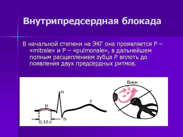 Замедление проводимости. Внутрипредсердная блокада 2 степени на ЭКГ. Нарушение внутрипредсердной проводимости на ЭКГ. Внутрипредсердная блокада 1 степени на ЭКГ что это такое. Внутрипредсердная блокада критерии на ЭКГ.