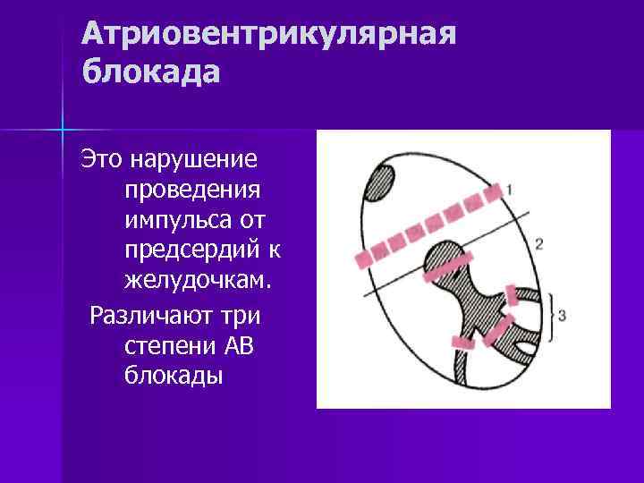 Атриовентрикулярная блокада Это нарушение проведения импульса от предсердий к желудочкам. Различают три степени АВ