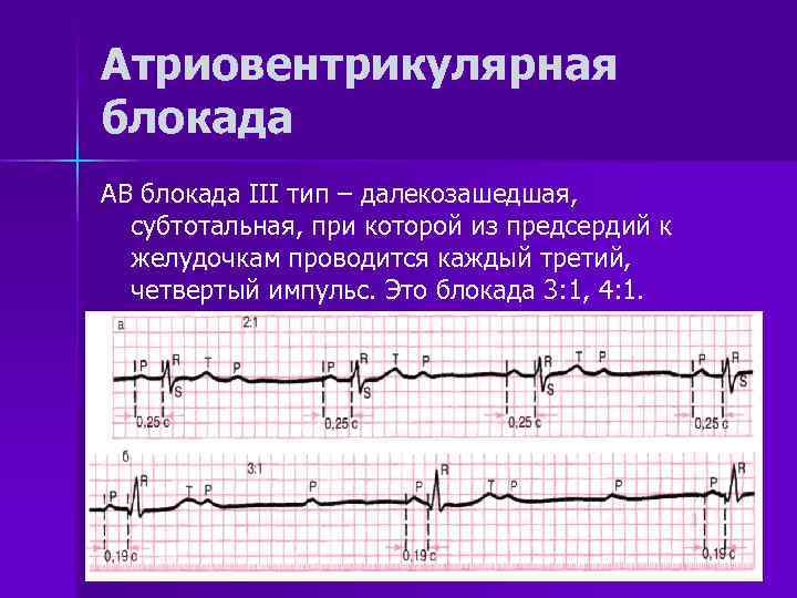 Полная ав блокада карта вызова скорой медицинской