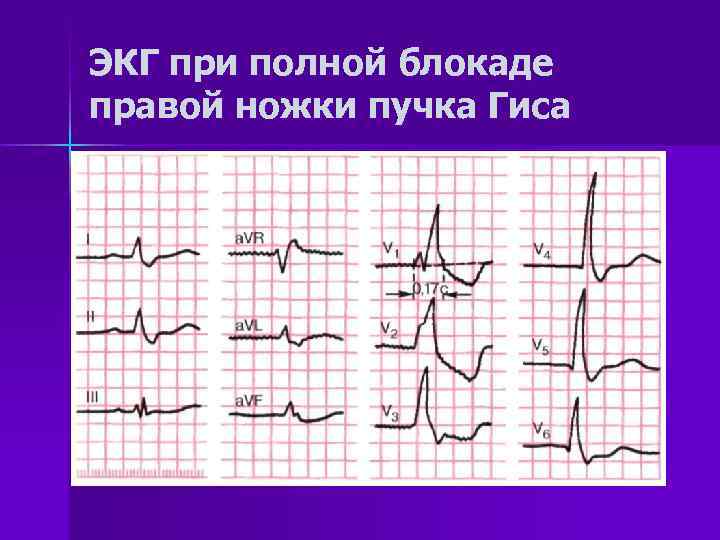 Экг нарушение проводимости у взрослых. Блокада ПНПГ на ЭКГ. ЭКГ при нарушении проводимости (блокады). Полная блокада сердца на ЭКГ. ЭКГ при блокадах сердца.