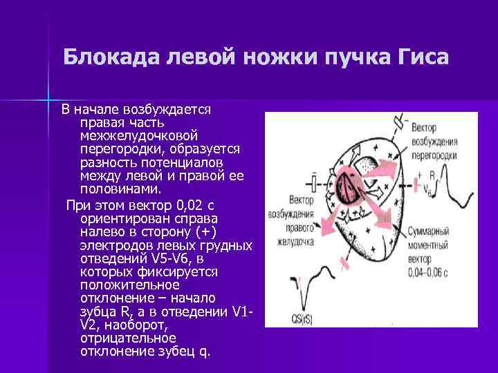 Левая ножка п гиса. Левая и правая блокада пучка Гиса. Блокада левая ножка пучка Гиса. Блокада 2 ножек пучка Гиса. ЭХОКГ при блокаде левой ножки пучка Гиса.