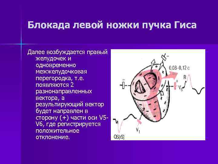 Блокада левой ножки пучка Гиса Далее возбуждается правый желудочек и одновременно межжелудочковая перегородка, т.