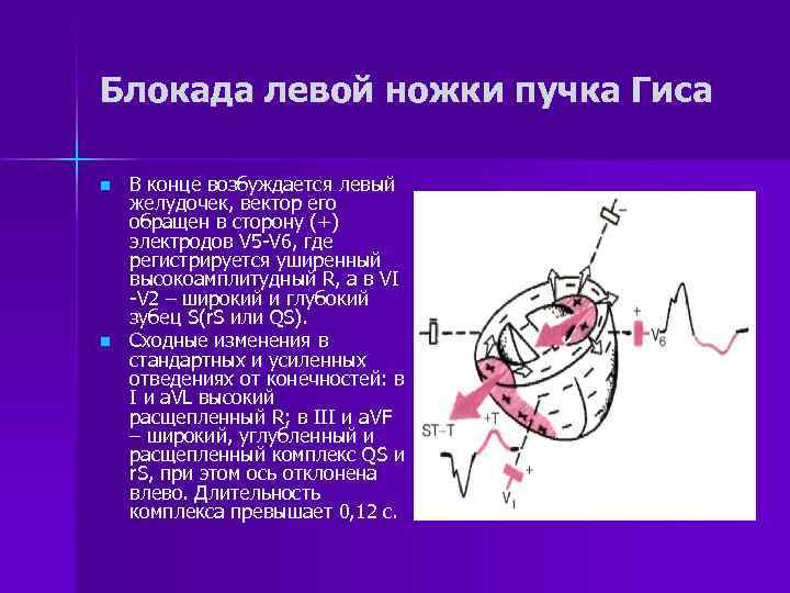 Блокада левого у сердца. Сердце пучок Гиса нарушение. Блокада левого желудочка пучка Гиса. Левый желудочек Гиса.