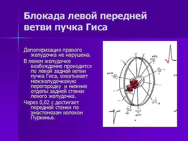 Блокада левой передней ветви пучка Гиса Деполяризация правого желудочка не нарушена. В левом желудочке