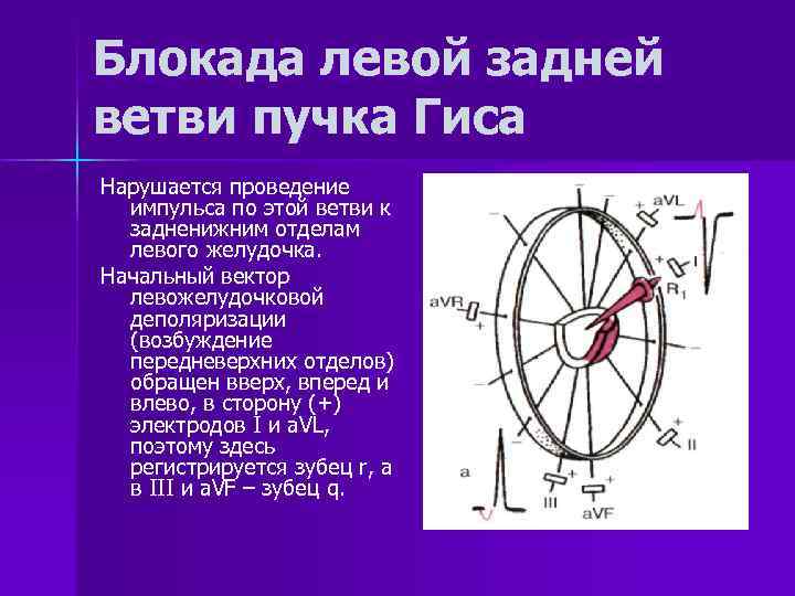Блокада левой задней ветви пучка Гиса Нарушается проведение импульса по этой ветви к задненижним