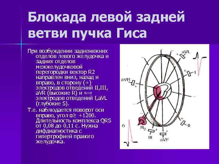 Блокада левой задней ветви пучка Гиса При возбуждении задненижних отделов левого желудочка и задних